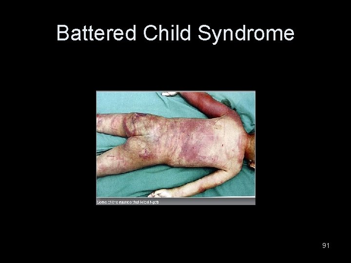 Battered Child Syndrome 91 