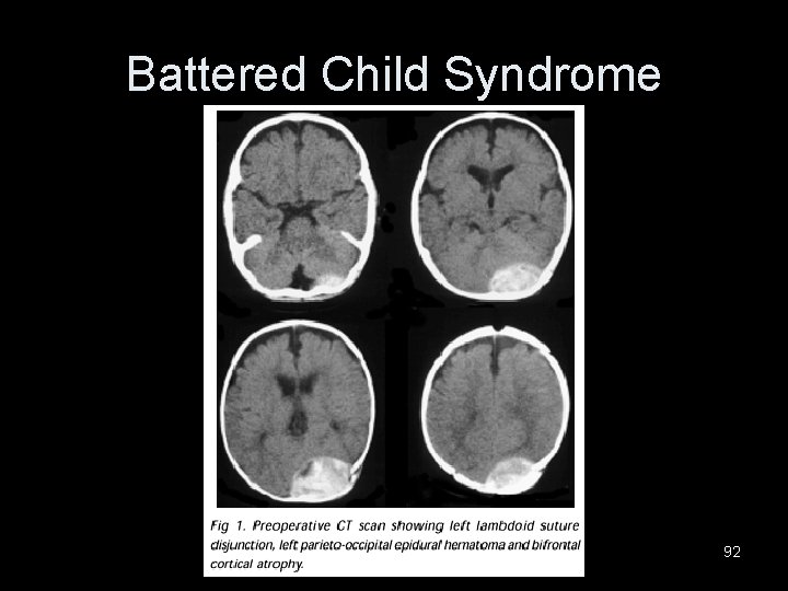Battered Child Syndrome 92 