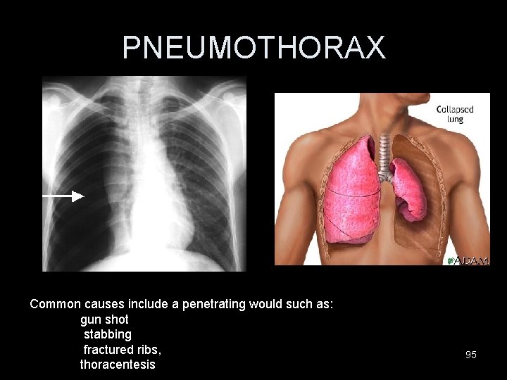 PNEUMOTHORAX Common causes include a penetrating would such as: gun shot stabbing fractured ribs,