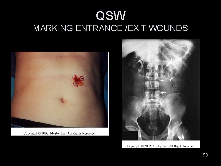 QSW MARKING ENTRANCE /EXIT WOUNDS 99 