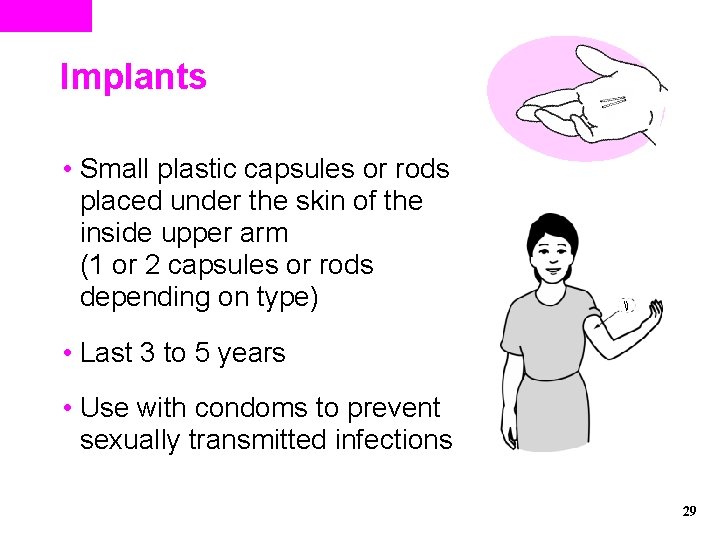 Implants • Small plastic capsules or rods placed under the skin of the inside Implants • Small plastic capsules or rods placed under the skin of the inside