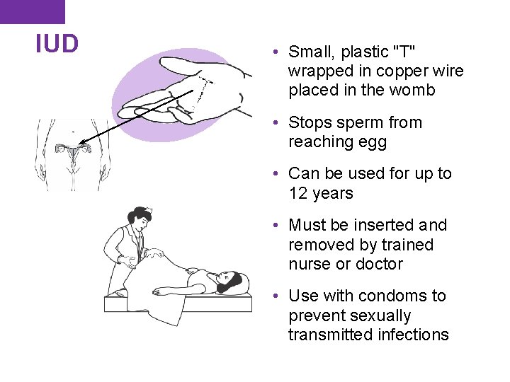 IUD • Small, plastic "T" wrapped in copper wire placed in the womb • IUD • Small, plastic "T" wrapped in copper wire placed in the womb •