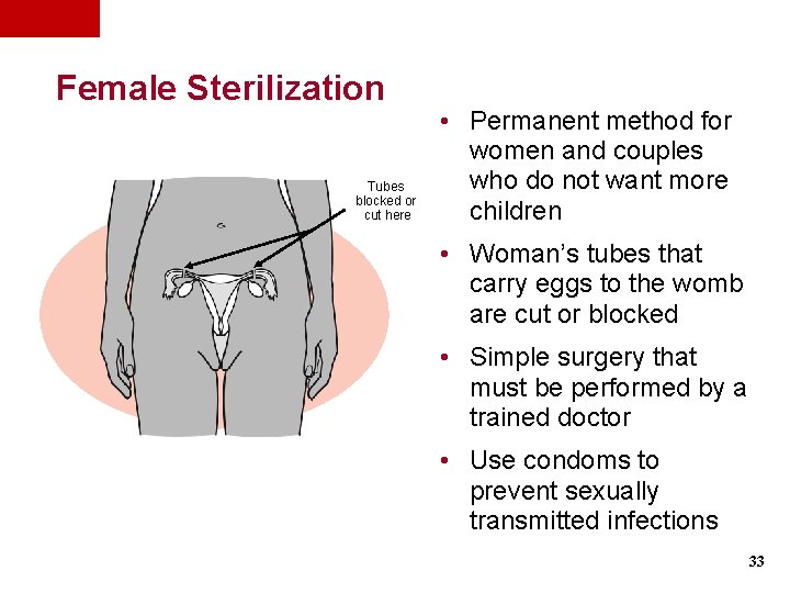Female Sterilization Tubes blocked or cut here • Permanent method for women and couples Female Sterilization Tubes blocked or cut here • Permanent method for women and couples