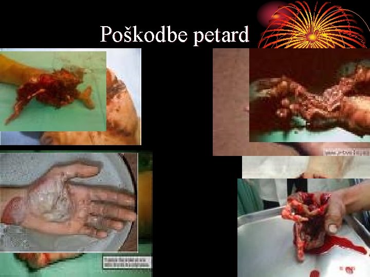 Poškodbe petard 