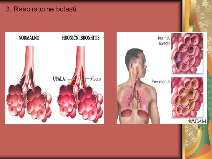 3. Respiratorne bolesti 