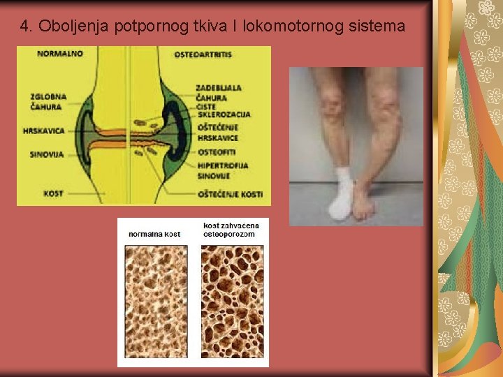 4. Oboljenja potpornog tkiva I lokomotornog sistema 