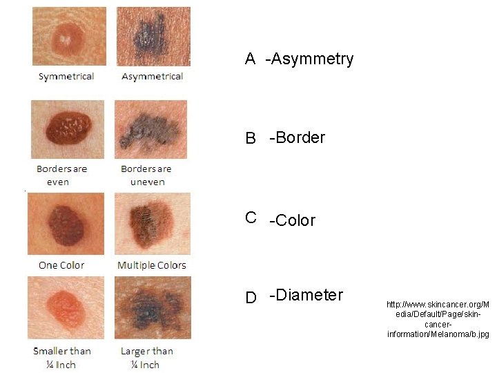 A -Asymmetry B -Border C -Color D -Diameter http: //www. skincancer. org/M edia/Default/Page/skincancerinformation/Melanoma/b. jpg