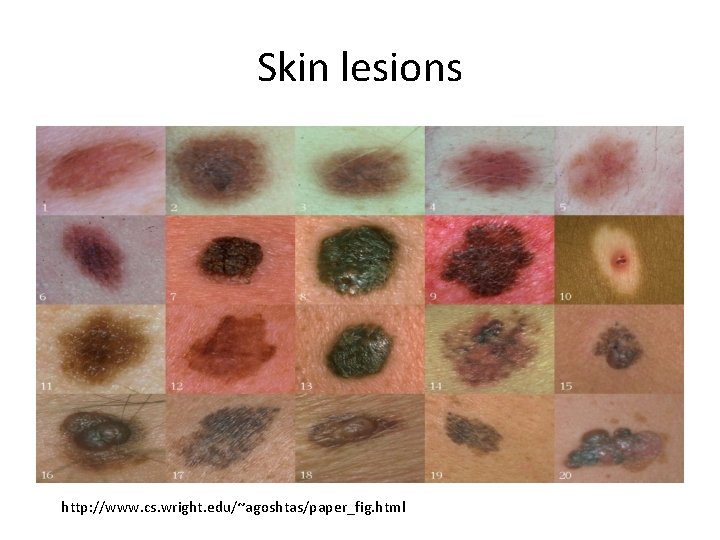 Skin lesions http: //www. cs. wright. edu/~agoshtas/paper_fig. html 