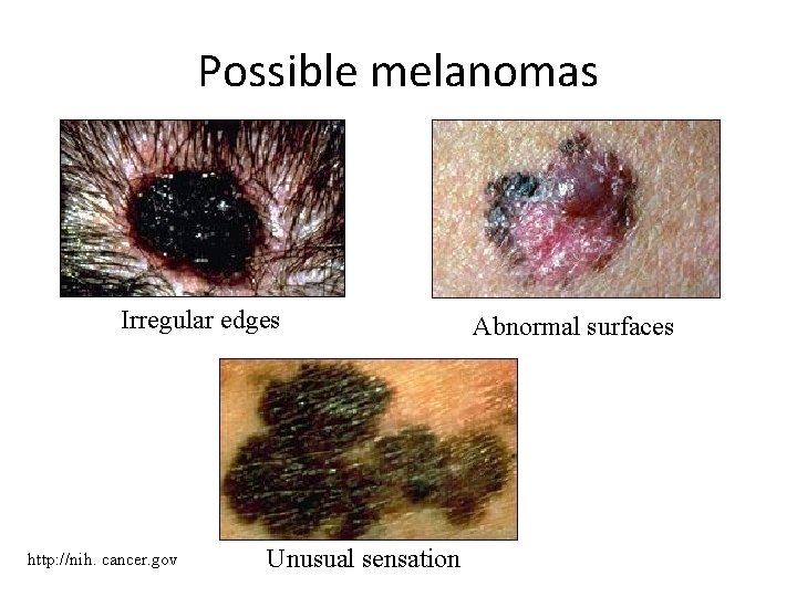 Possible melanomas Irregular edges http: //nih. cancer. gov Unusual sensation Abnormal surfaces 