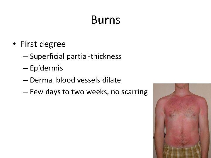 Burns • First degree – Superficial partial-thickness – Epidermis – Dermal blood vessels dilate