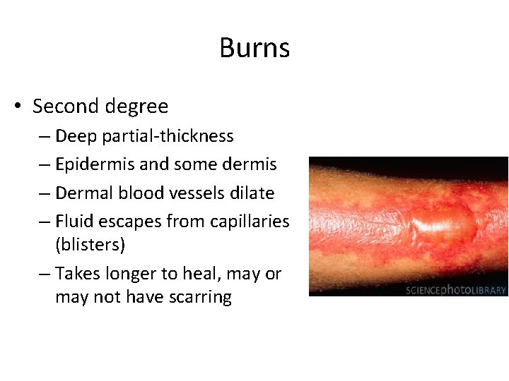 Burns • Second degree – Deep partial-thickness – Epidermis and some dermis – Dermal