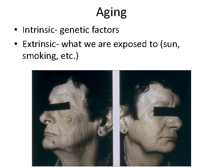 Aging • Intrinsic- genetic factors • Extrinsic- what we are exposed to (sun, smoking,