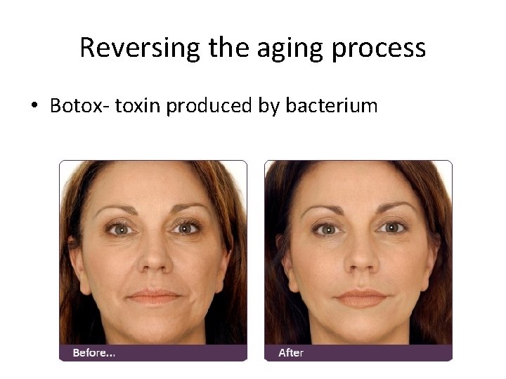 Reversing the aging process • Botox- toxin produced by bacterium 