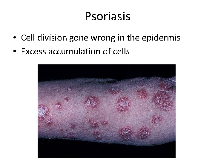 Psoriasis • Cell division gone wrong in the epidermis • Excess accumulation of cells