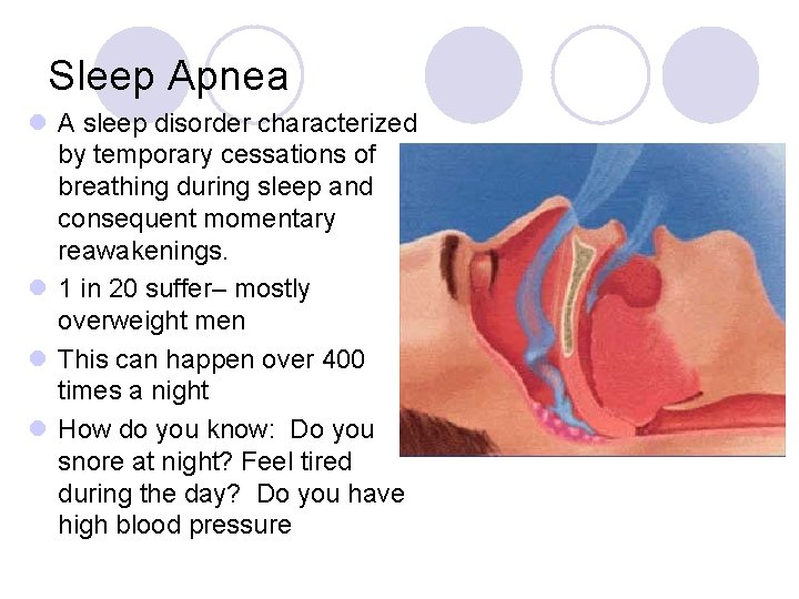 Sleep Apnea l A sleep disorder characterized by temporary cessations of breathing during sleep