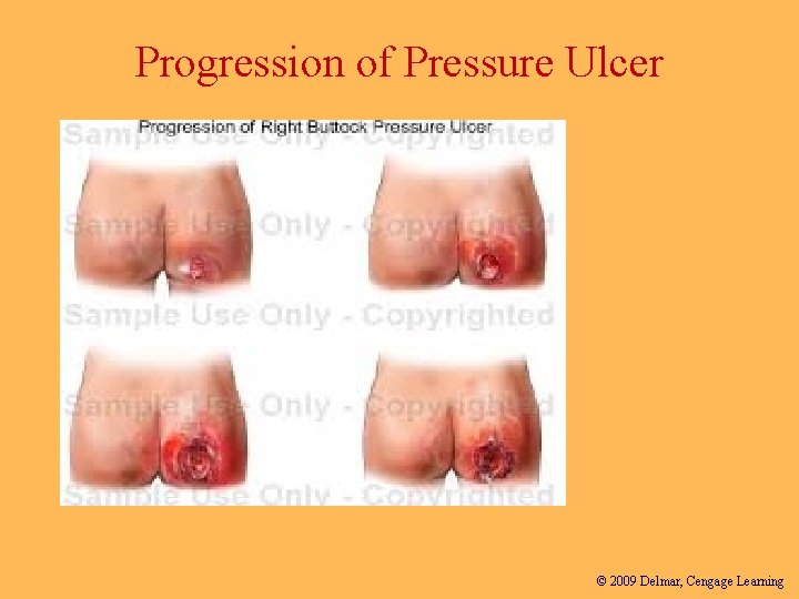Progression of Pressure Ulcer © 2009 Delmar, Cengage Learning 