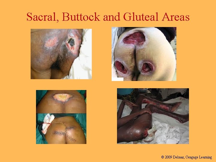 Sacral, Buttock and Gluteal Areas © 2009 Delmar, Cengage Learning 