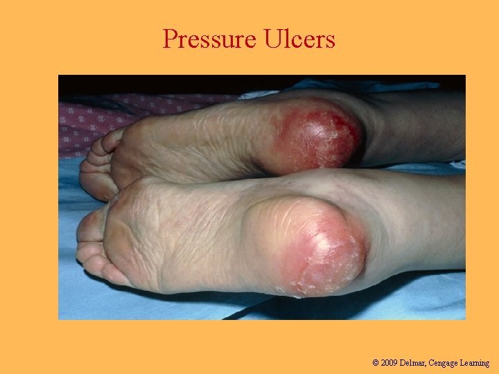 Pressure Ulcers © 2009 Delmar, Cengage Learning 