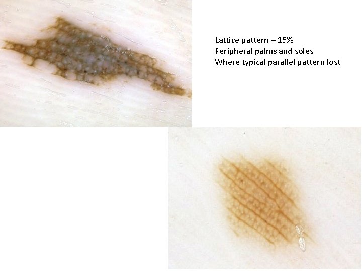 Lattice pattern – 15% Peripheral palms and soles Where typical parallel pattern lost Lattice pattern – 15% Peripheral palms and soles Where typical parallel pattern lost