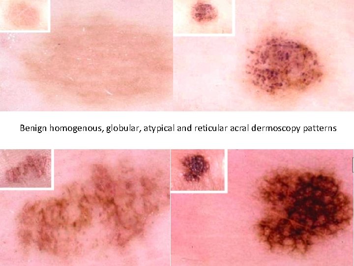 Benign homogenous, globular, atypical and reticular acral dermoscopy patterns Benign homogenous, globular, atypical and reticular acral dermoscopy patterns