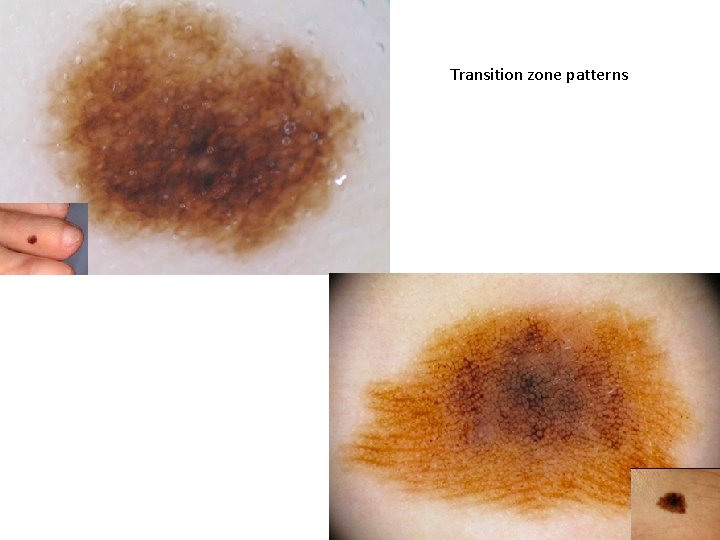 Transition zone patterns Transition zone patterns