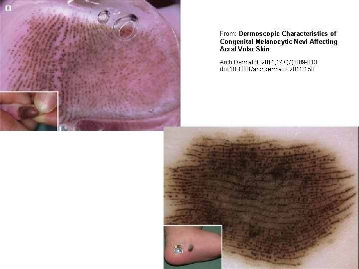 From: Dermoscopic Characteristics of Congenital Melanocytic Nevi Affecting Acral Volar Skin Arch Dermatol. 2011; From: Dermoscopic Characteristics of Congenital Melanocytic Nevi Affecting Acral Volar Skin Arch Dermatol. 2011;