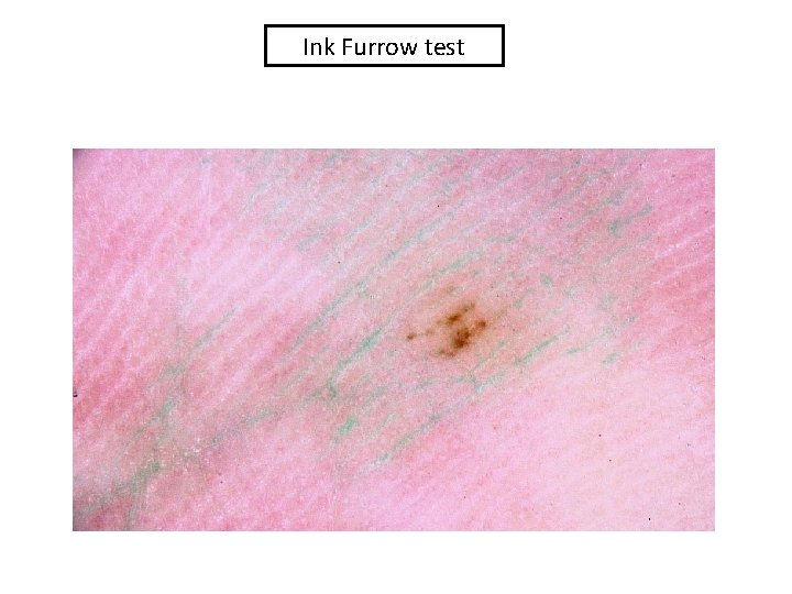 Ink Furrow test Ink Furrow test