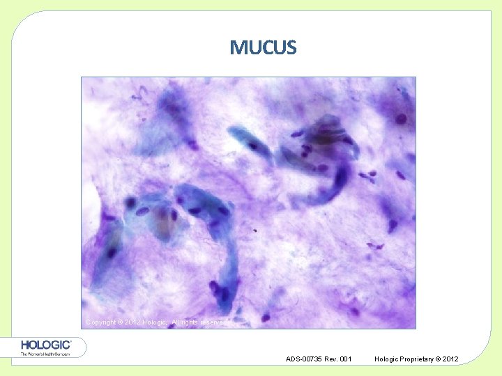 MUCUS Copyright © 2012 Hologic, All rights reserved. ADS-00735 Rev. 001 Hologic Proprietary ©