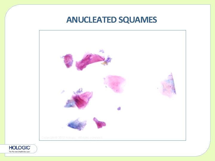 ANUCLEATED SQUAMES Copyright © 2012 Hologic, All rights reserved. 