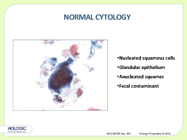 NORMAL CYTOLOGY • Nucleated squamous cells • Glandular epithelium • Anucleated squames • Fecal