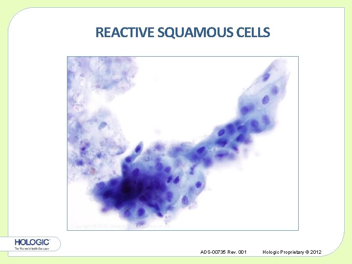 REACTIVE SQUAMOUS CELLS Copyright © 2012 Hologic, All rights reserved. ADS-00735 Rev. 001 Hologic