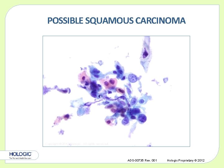 POSSIBLE SQUAMOUS CARCINOMA Copyright © 2012 Hologic, All rights reserved. ADS-00735 Rev. 001 Hologic