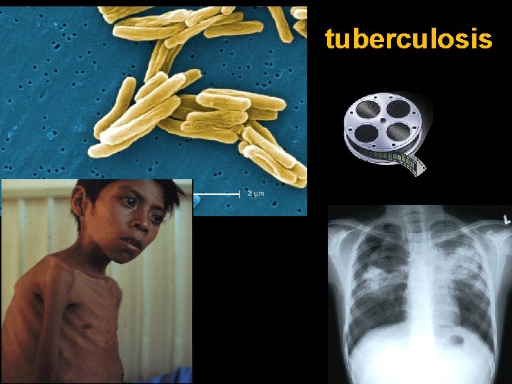 tuberculosis 