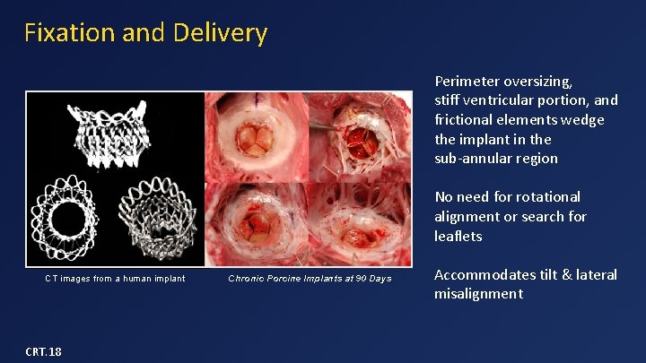 Fixation and Delivery Perimeter oversizing, stiff ventricular portion, and frictional elements wedge the implant