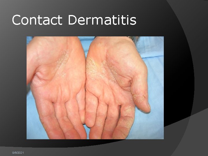 Contact Dermatitis 9/6/2021 