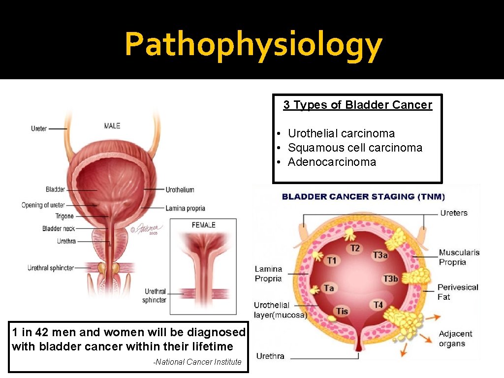 Pathophysiology 3 Types of Bladder Cancer • Urothelial carcinoma • Squamous cell carcinoma •