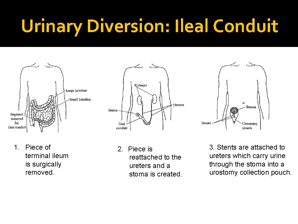 Urinary Diversion: Ileal Conduit 1. Piece of terminal ileum is surgically removed. 2. Piece