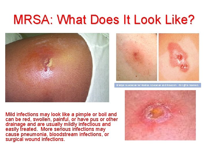 MRSA: What Does It Look Like? Mild infections may look like a pimple or