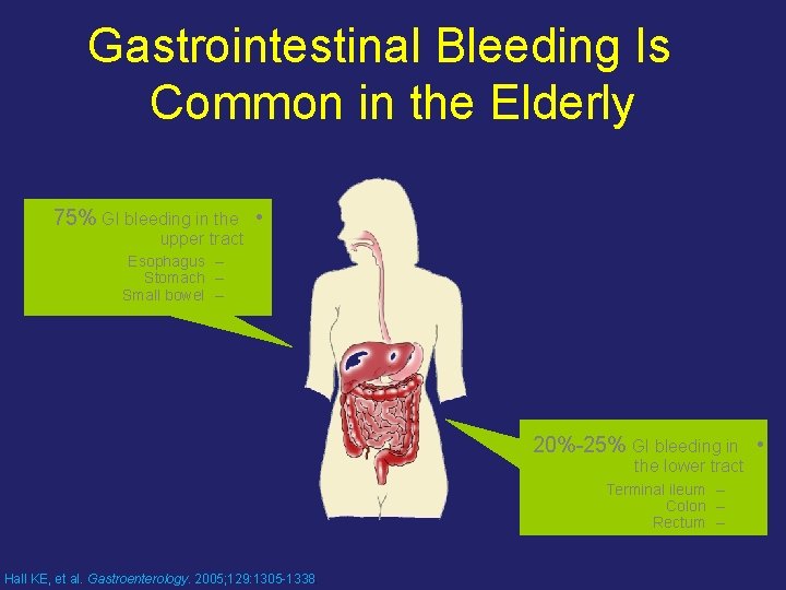 Gastrointestinal Bleeding Is Common in the Elderly 75% GI bleeding in the • upper