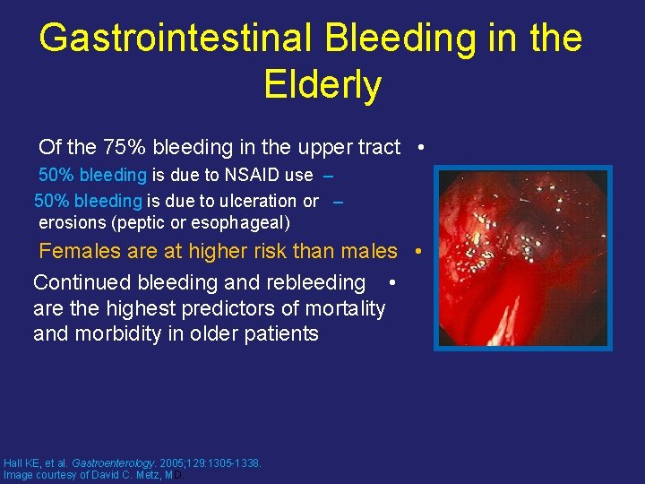 Gastrointestinal Bleeding in the Elderly Of the 75% bleeding in the upper tract •