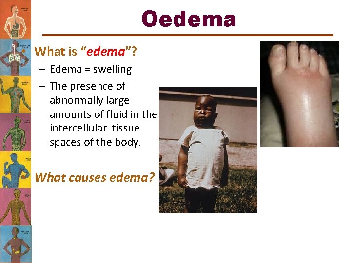 Oedema • What is “edema”? – Edema = swelling – The presence of abnormally