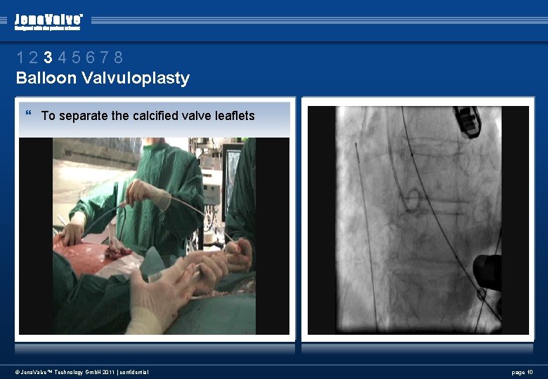 12345678 Balloon Valvuloplasty } To separate the calcified valve leaflets © Jena. Valve™ Technology 12345678 Balloon Valvuloplasty } To separate the calcified valve leaflets © Jena. Valve™ Technology