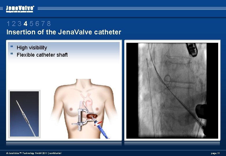 12345678 Insertion of the Jena. Valve catheter } High visibility } Flexible catheter shaft 12345678 Insertion of the Jena. Valve catheter } High visibility } Flexible catheter shaft