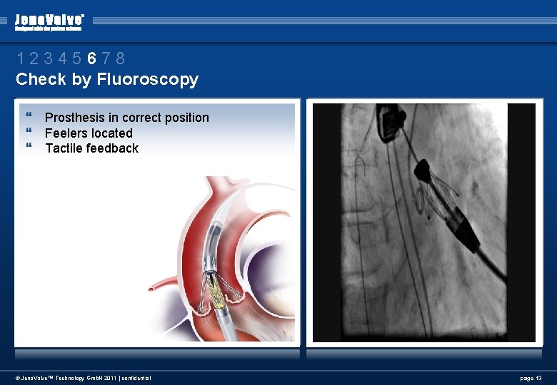 12345678 Check by Fluoroscopy } Prosthesis in correct position } Feelers located } Tactile 12345678 Check by Fluoroscopy } Prosthesis in correct position } Feelers located } Tactile