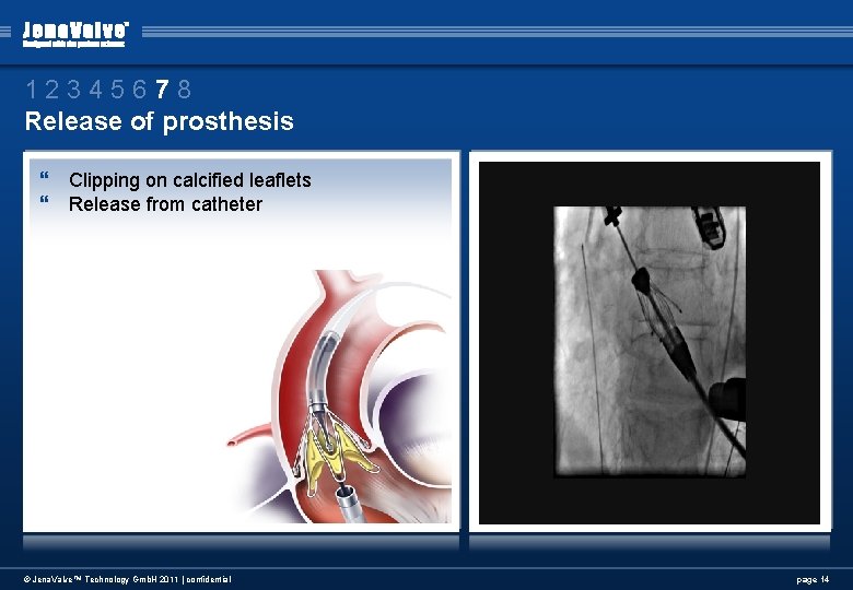 12345678 Release of prosthesis } Clipping on calcified leaflets } Release from catheter © 12345678 Release of prosthesis } Clipping on calcified leaflets } Release from catheter ©