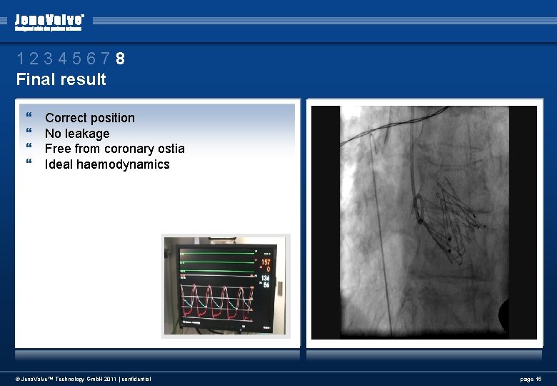 12345678 Final result } } Correct position No leakage Free from coronary ostia Ideal 12345678 Final result } } Correct position No leakage Free from coronary ostia Ideal