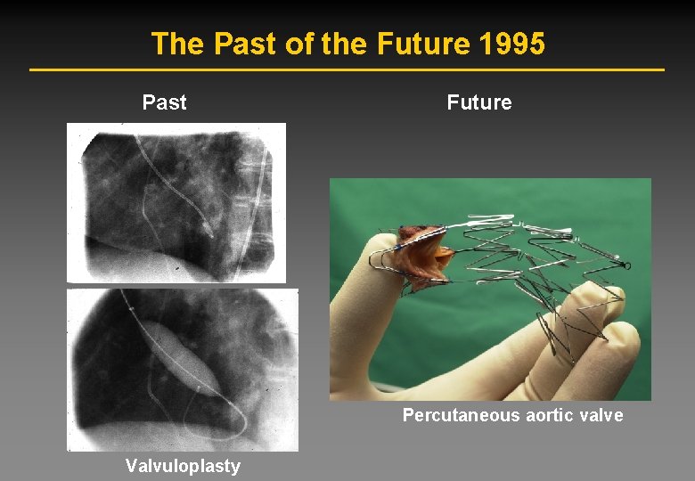The Past of the Future 1995 Past Future Percutaneous aortic valve Valvuloplasty The Past of the Future 1995 Past Future Percutaneous aortic valve Valvuloplasty