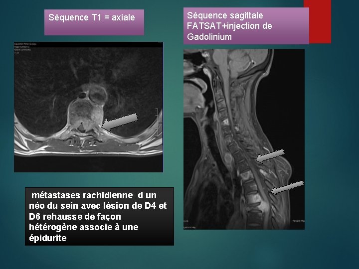 Séquence T 1 = axiale métastases rachidienne d un néo du sein avec lésion