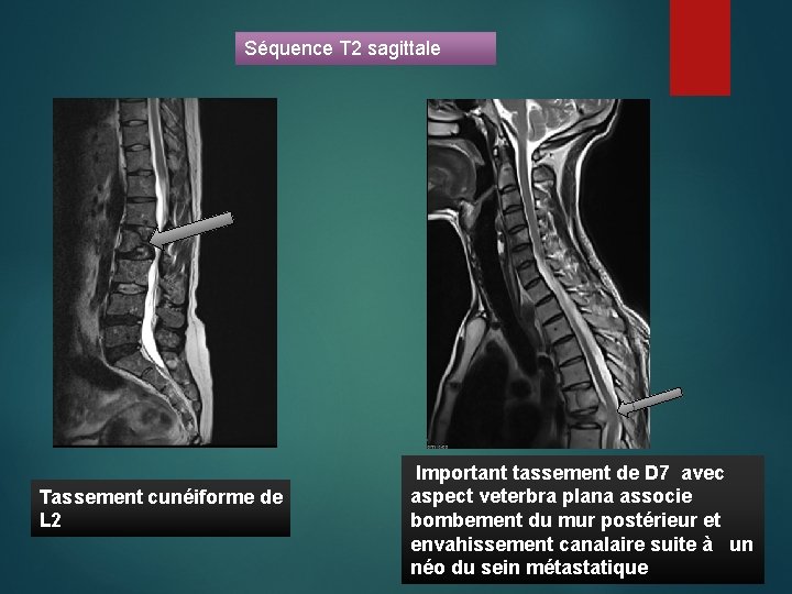 Séquence T 2 sagittale Tassement cunéiforme de L 2 Important tassement de D 7