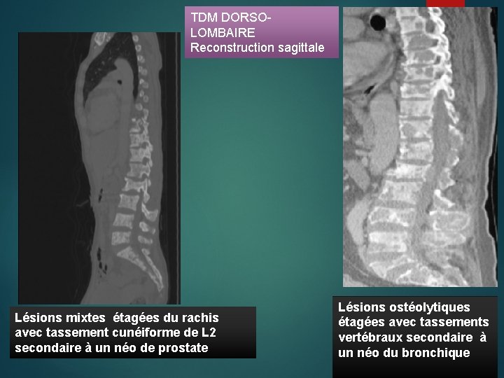 TDM DORSOLOMBAIRE Reconstruction sagittale Lésions mixtes étagées du rachis avec tassement cunéiforme de L